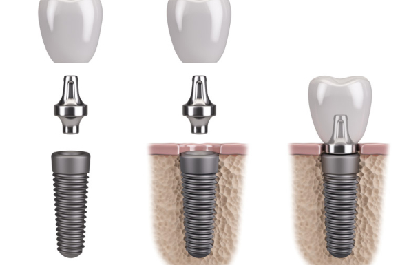 Dental Implants