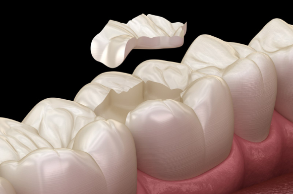 Porcelain Dental Onlays 