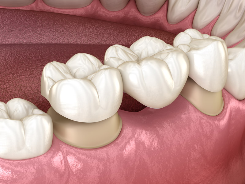 Dental Bridges