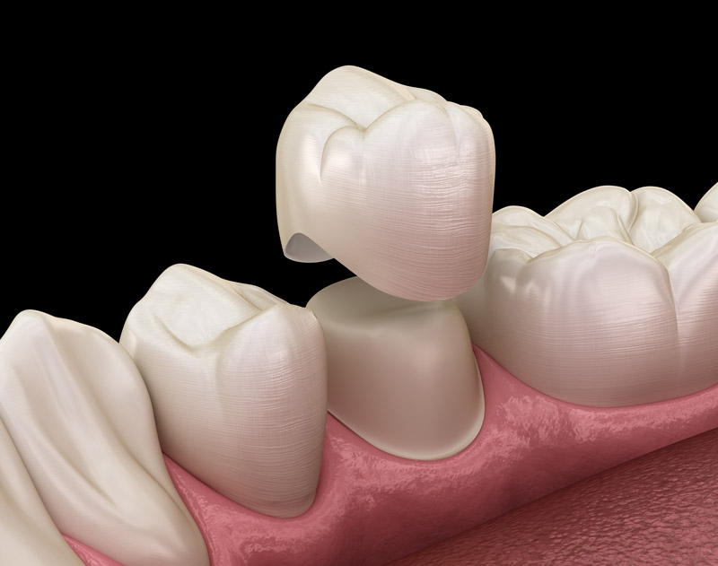 Example of CEREC Same-Day Dental Crowns