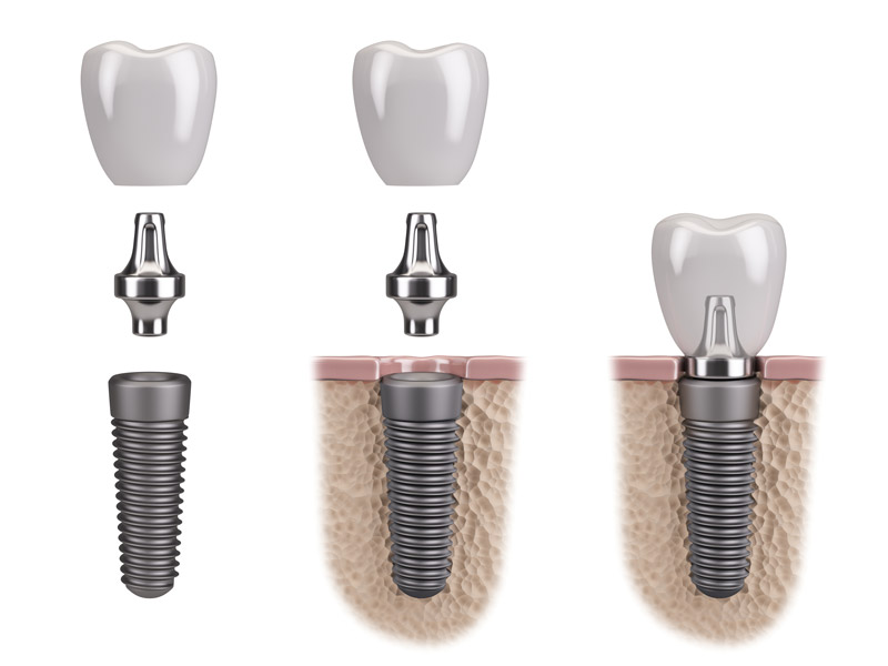 Dental Implants