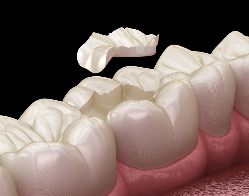 Porcelain Dental Onlays