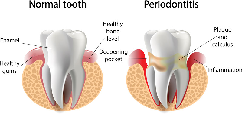 Periodontal Therapy